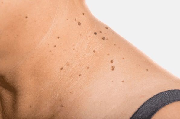 Are you looking for easy skin tag removal Kelvindale - then contact Spire today!