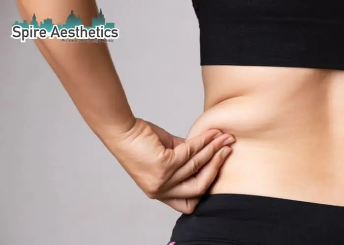 Image of woman pinching fat on their hips Kelvindale. Fat Freezing treatment
