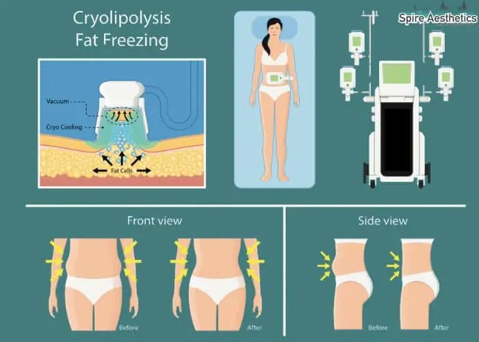 Fat freezing treatment Kelvindale benefits for competitions to remove stubborn fat deposits.