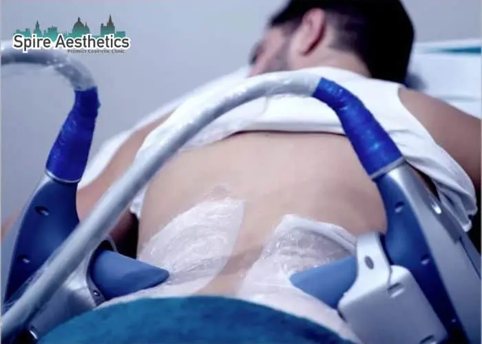 Man having fat freezing treatment done on love handles before a competitions Kelvindale to create a sculpted look.