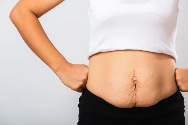 Image of a woman's stomach after weight loss with sagging skin following a gastric band Kelvindale
