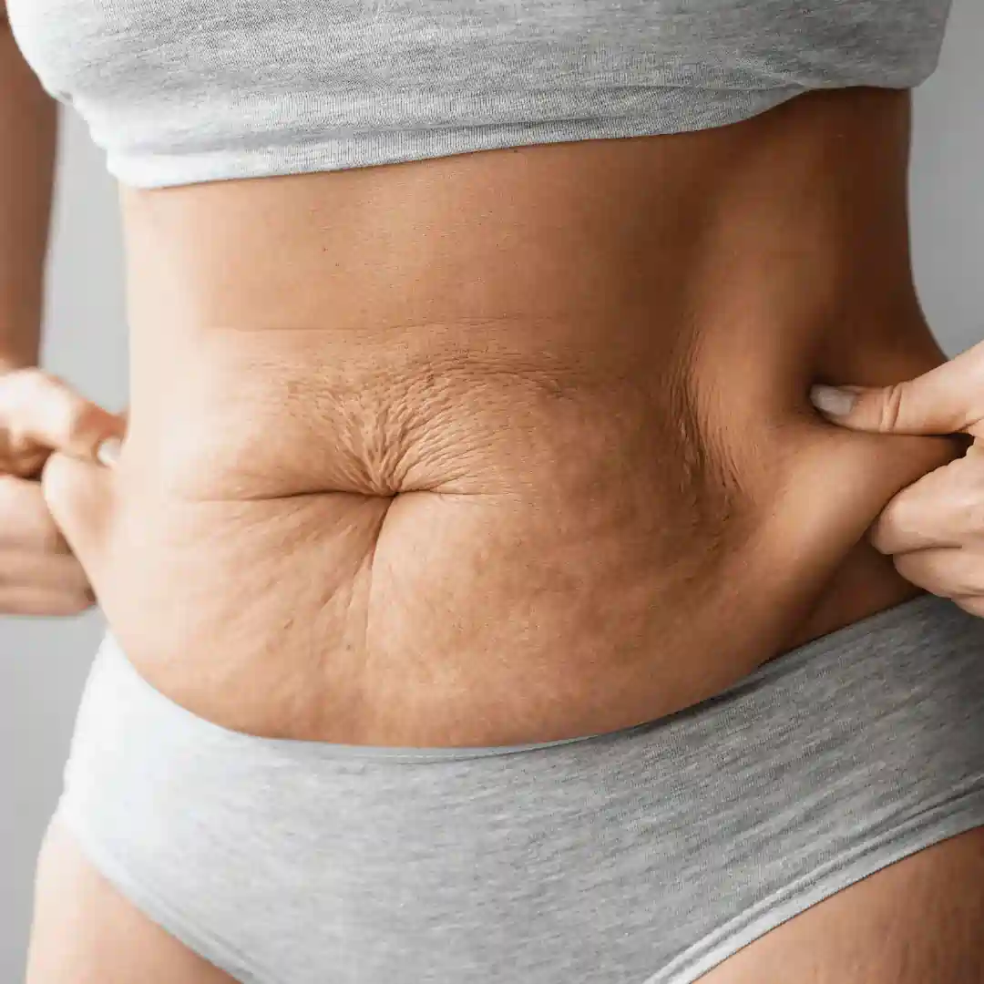 Is It Normal to Have Loose Skin After Pregnancy Kelvindale?